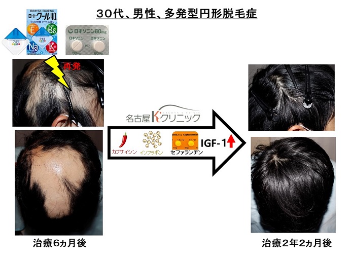 円形脱毛症　病院